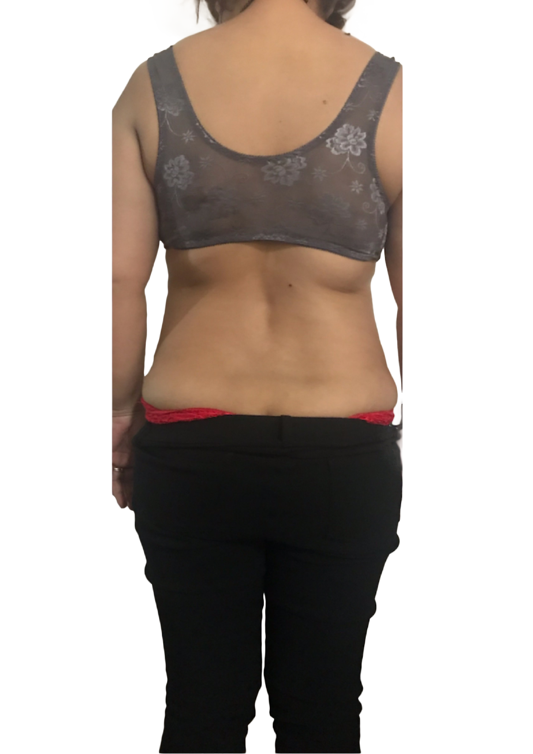 After back contouring treatment