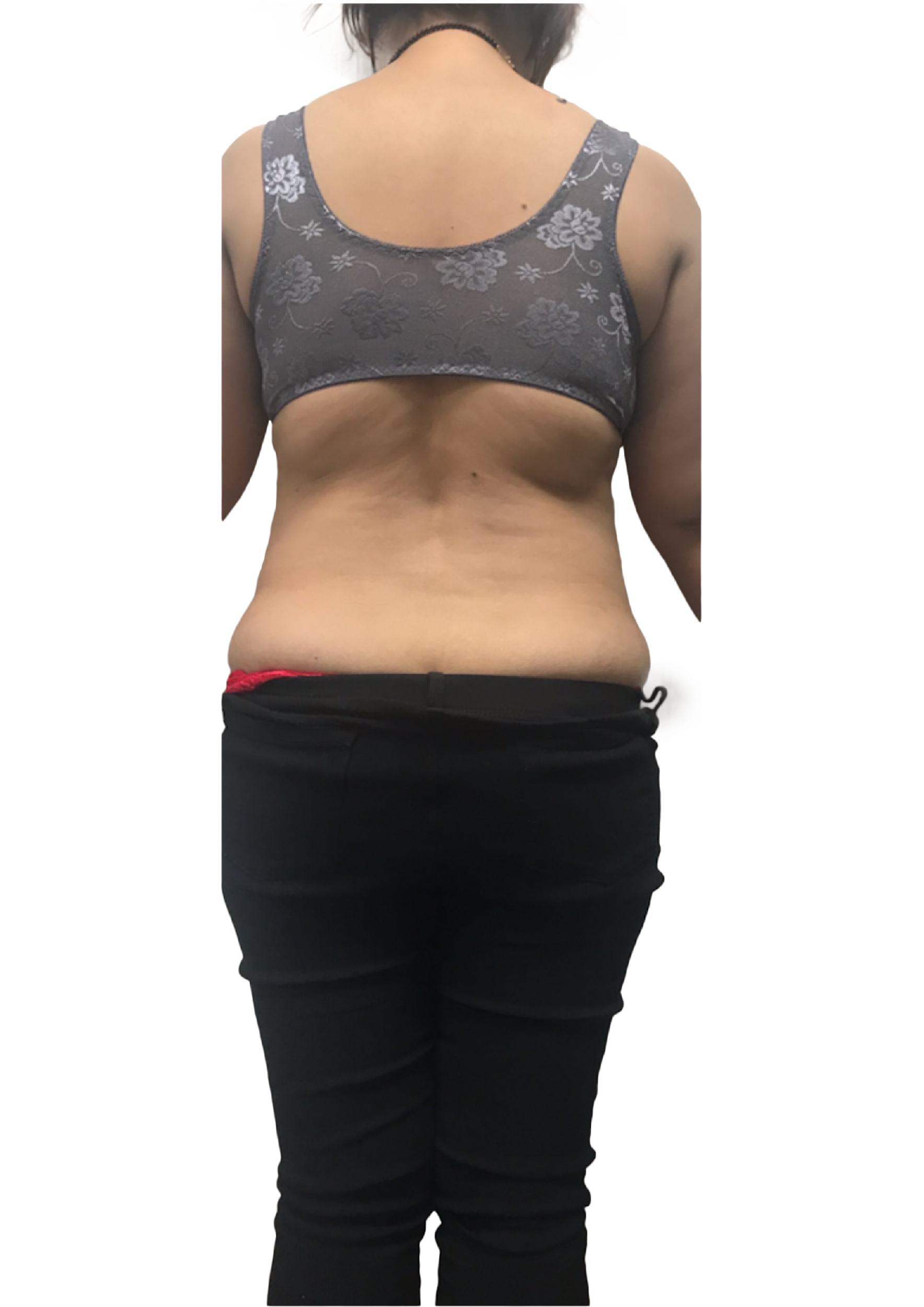 Before back contouring treatment