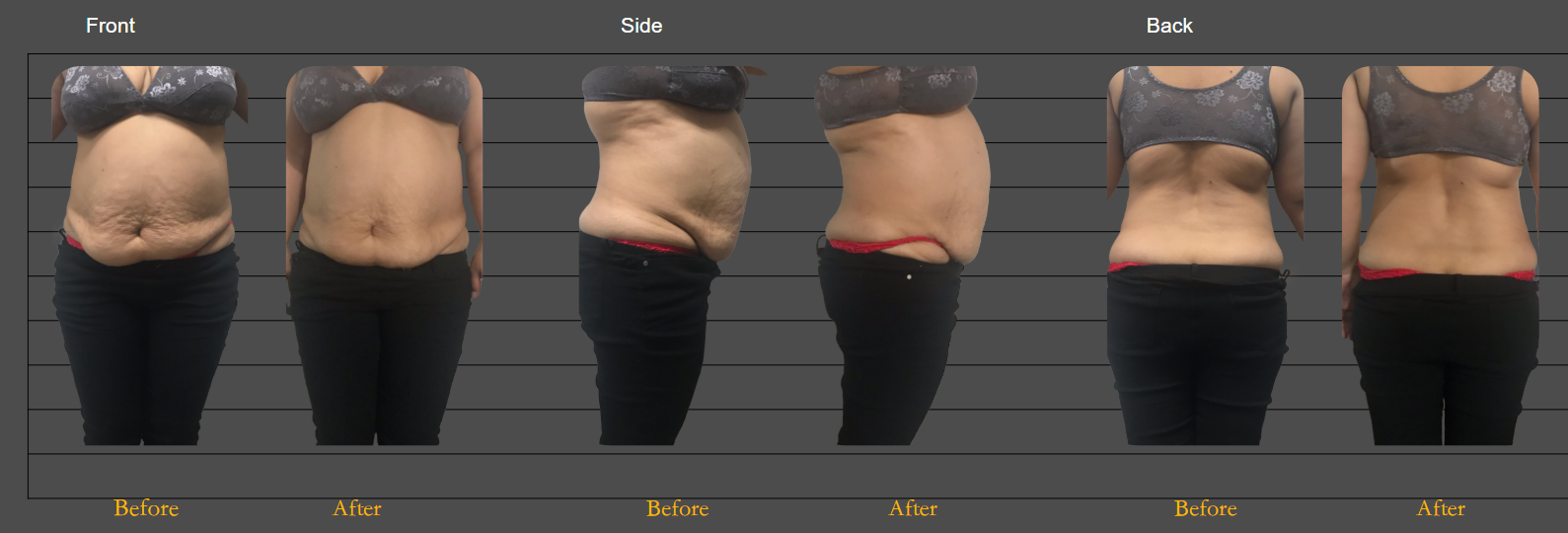 CaviZero body shaping before and after results - front, side and back views