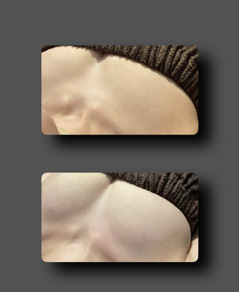 Chest and bust treatment before and after comparison